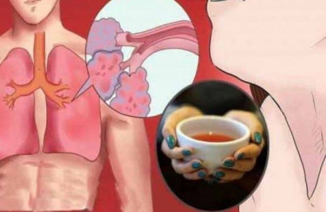 Kako izbaciti šlajm iz grla i pluća, kao i sekret iz sinusa prirodnim putem