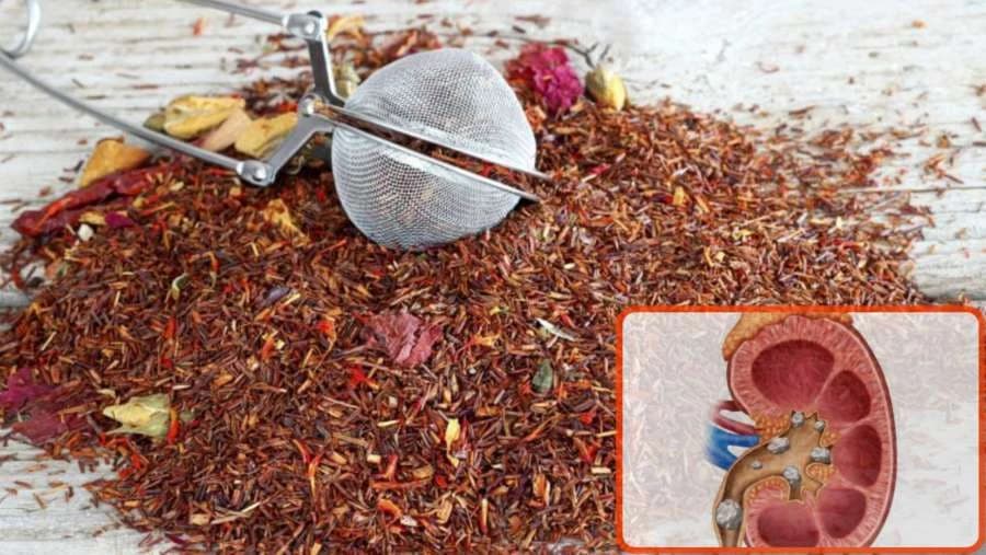 Liječenje kamenca u bubregu uz pomoć ove mješavine čaja koju možete sami napraviti