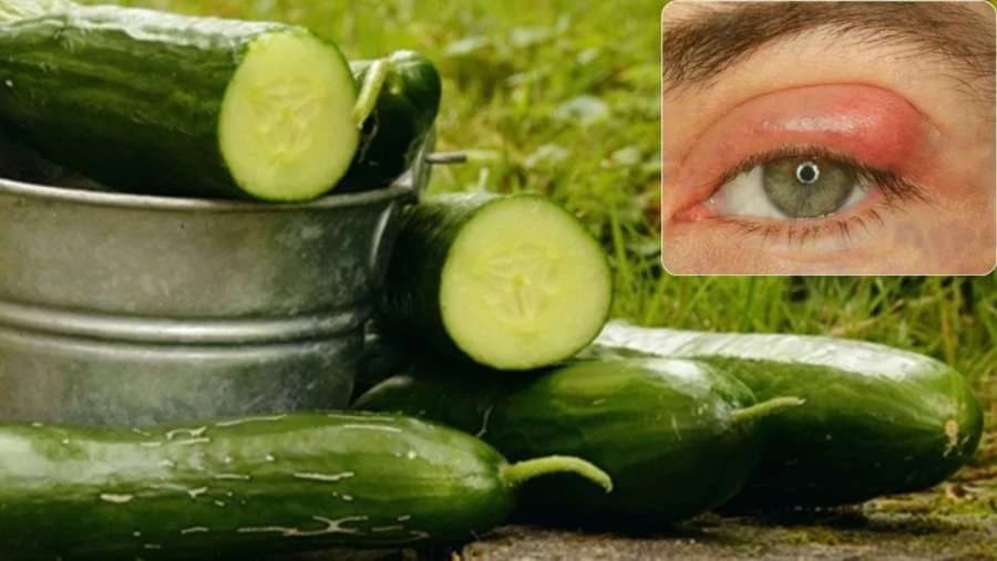 Prirodni načini da se riješite čmička na oku