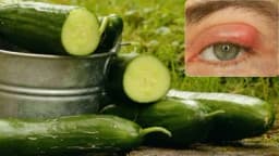 Prirodni načini da se riješite čmička na oku