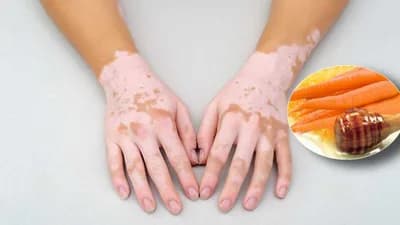 Vitiligo - Liječenje uz pomoć prirodnih lijekova