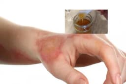 Najbolji kućni lijekovi za opekotine, a ove nikako nemojte koristiti!